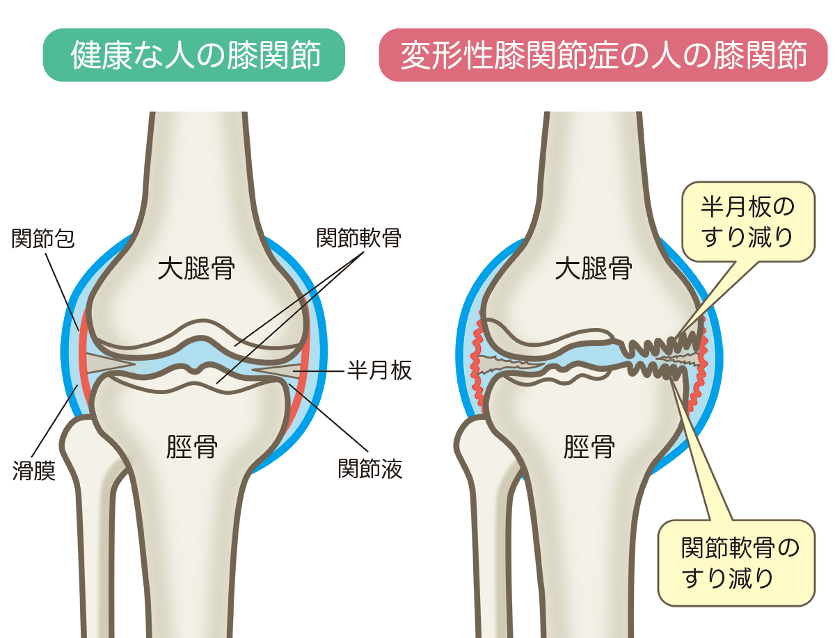 変形性膝関節症のイラスト